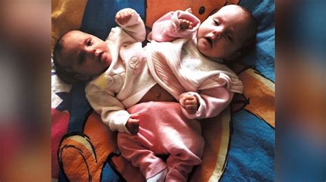 gabby garcia conjoined twin|Barstow conjoined twin dies at 13